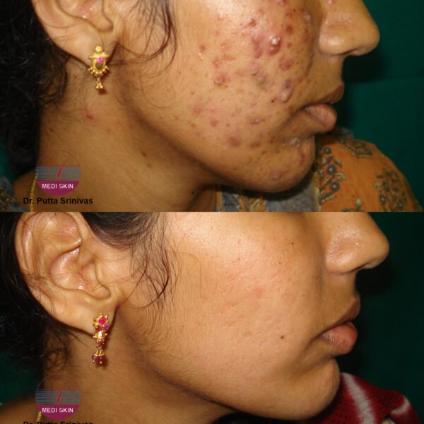 ACNE-PEELS-SWATHI