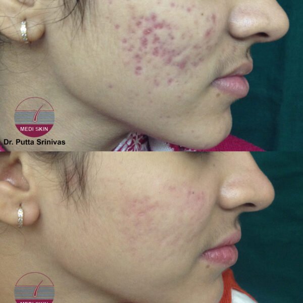 ACNE SCARS-SANJANA