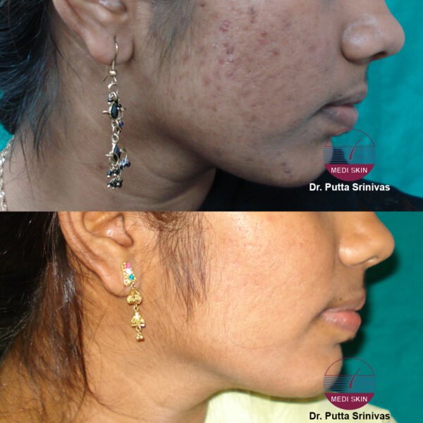 ACNE-SHAILAJA