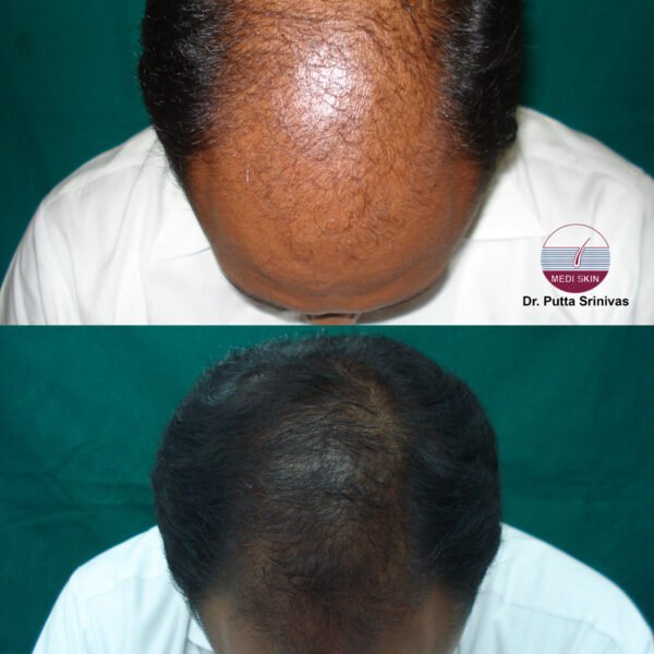 Androgenic alopecia-Ravikanth