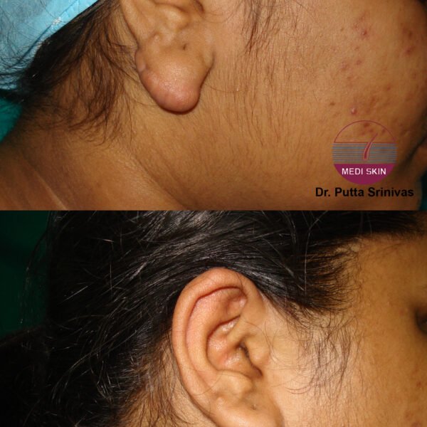 KELOID-ANUSHA