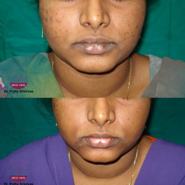 VITILIGO-LIPS-JAYAPRADA