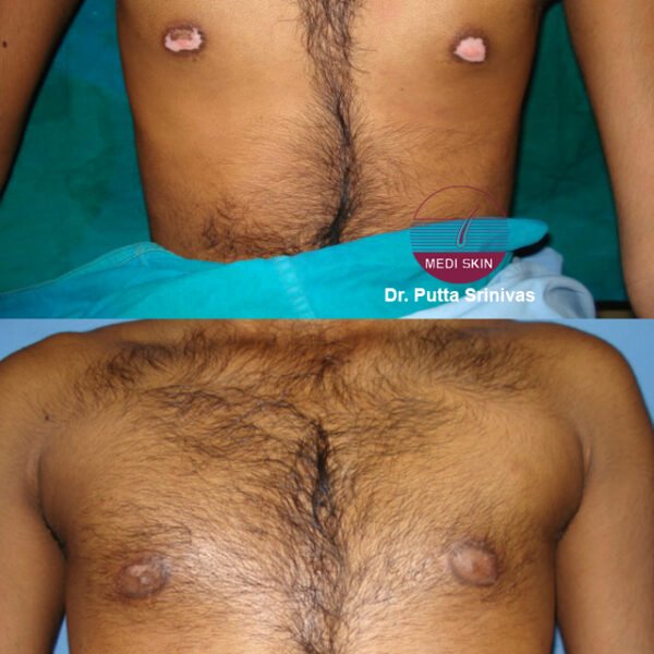 Vitiligo chest-Brahmaiah